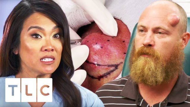 Dr. Lee Squeezes An 18 Year Old Cyst!