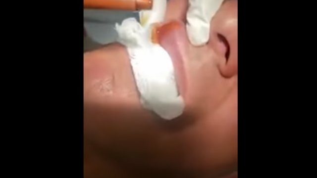 Amazing botfly removal on lips