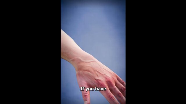 Removing ganglion cysts [VIDEO]
