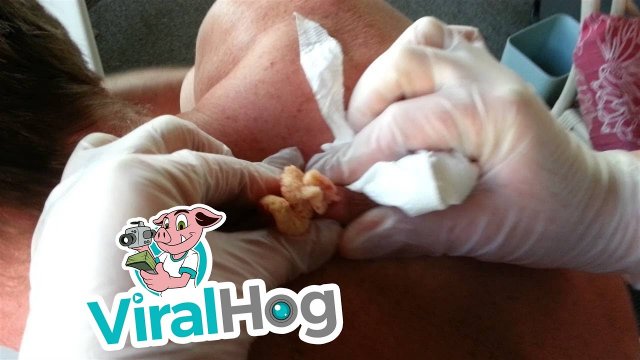 30 Year Old Cyst Explosion